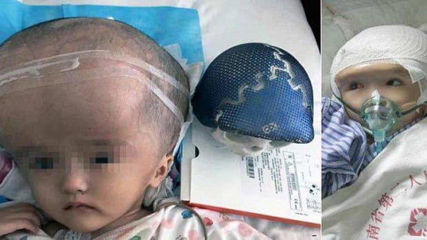 chinese-toddler-gets-world's-first-3d-printed-skull-implant