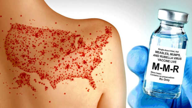 measles-outbreaks-failed-vaccines-feature-800x417