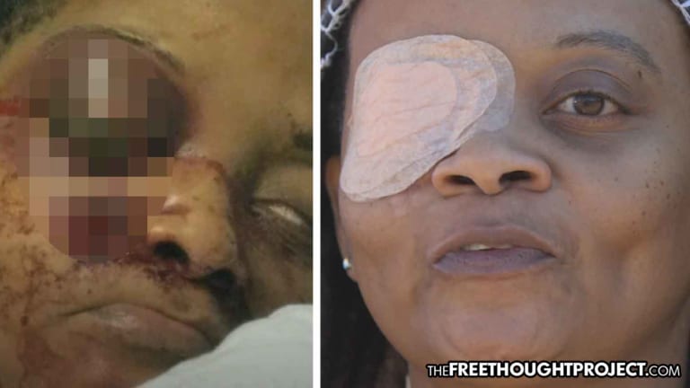 Woman Blind in One Eye After Cop Blasted It Out with 400 MPH Pepper Spray Gun