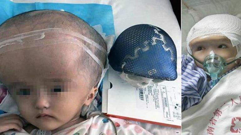 Chinese Toddler Receives the World's First 3-D Printed Skull Replacement