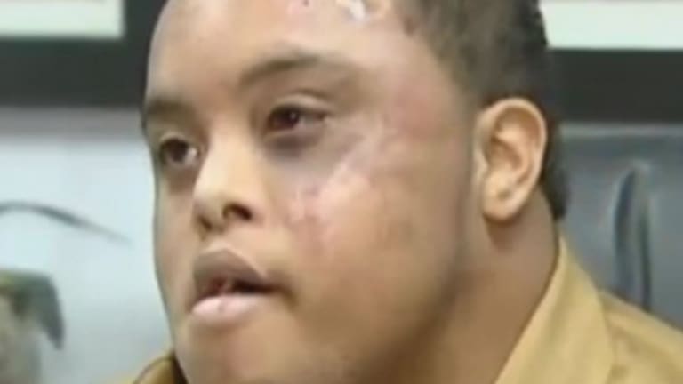 22 Year Old With Down Syndrome Beaten By The Police For ‘Bulge In Pants’ That Was Only A Colostomy Bag