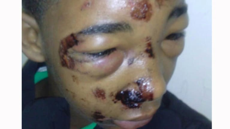 Cops Taser 14 Year Old Boy in the Face, While he is Handcuffed