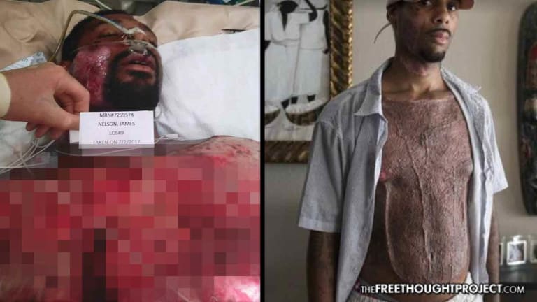 Cops Held Mentally Ill Man Down on Scorching Asphalt Until His Skin Literally Melted Off