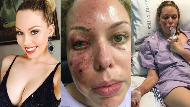 Miss Australia Left Disfigured Because Police Threw a Flashbang Grenade into Her Bed as She Slept