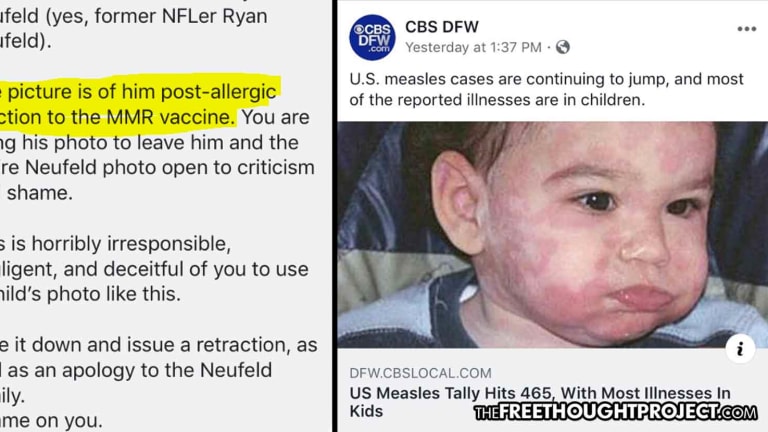 Mom Catches CBS Using Image of Her Vaccine-Injured Child, Falsely Claiming Measles Caused It