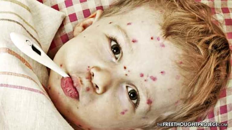 School Bans Unvaccinated Kids After Immunized Children Start Chickenpox Outbreak