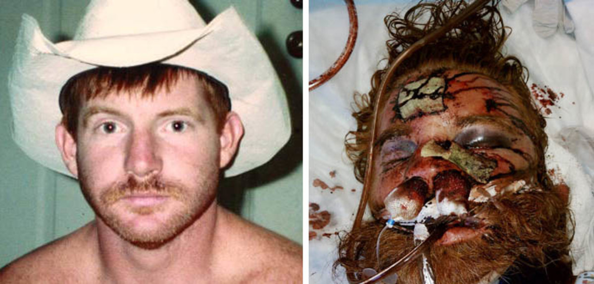 Before and after photos illustrate extent of Thomas' injuries.