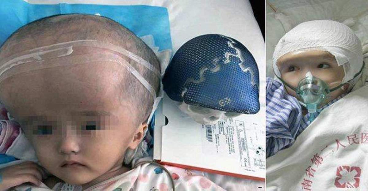 chinese-toddler-gets-world's-first-3d-printed-skull-implant