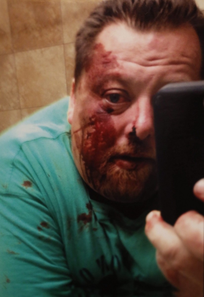 Picture of Christopher J. Kozak after his beating by Buffalo Police.