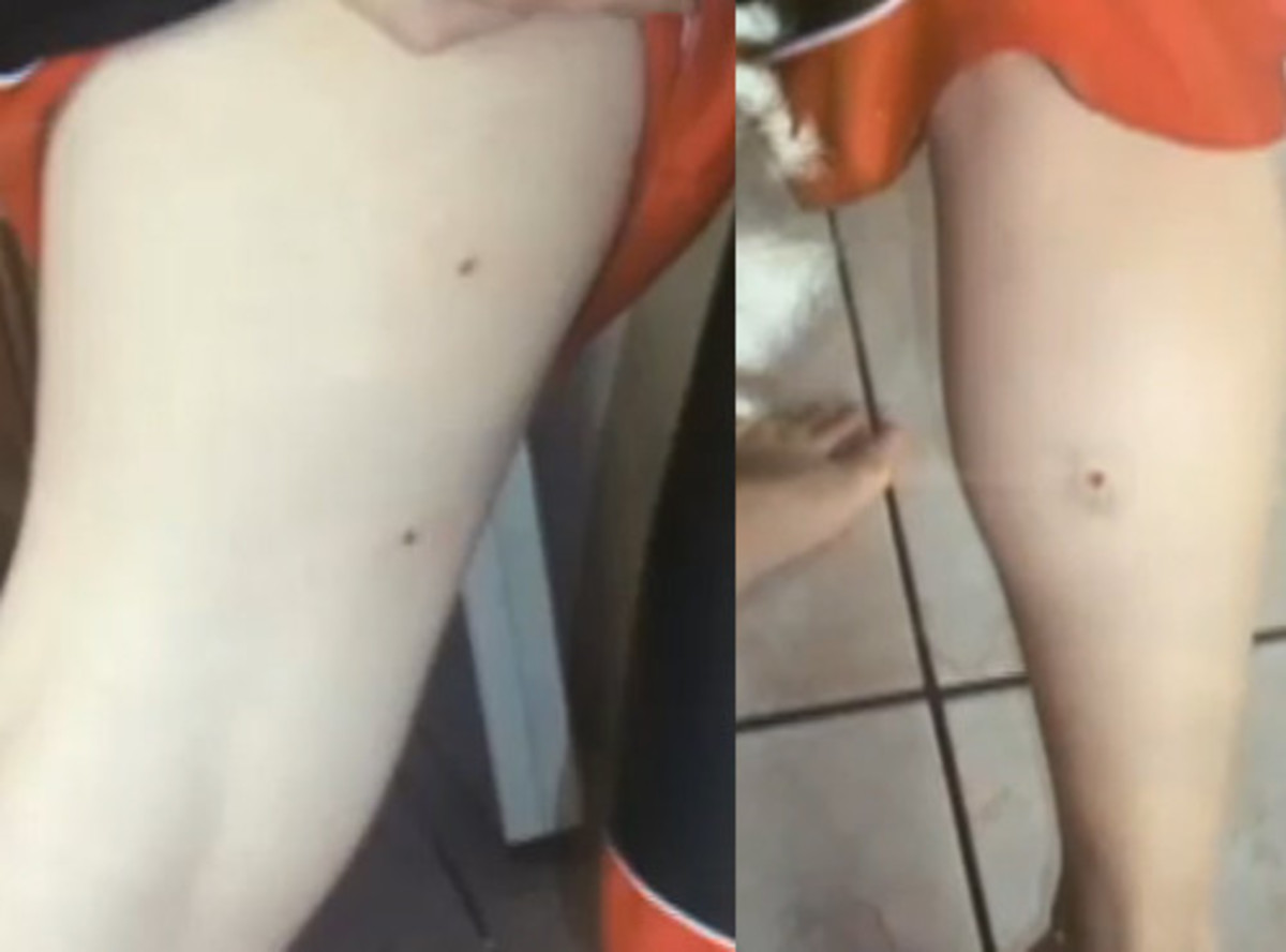Bullet holes in the legs of the 17-year-old